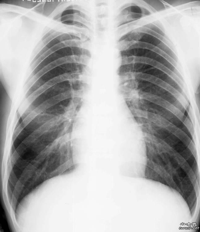 求助正常肺部x光片图片供教学用